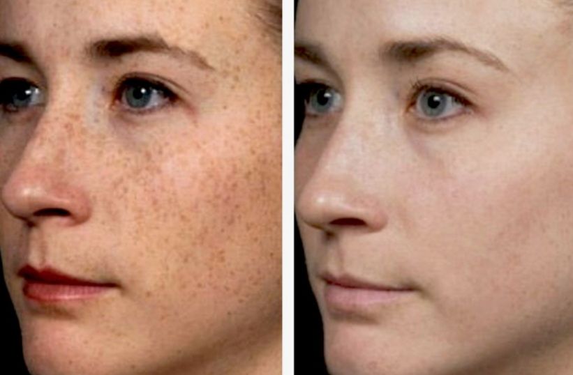 Before &After